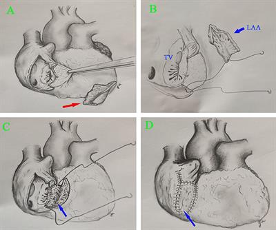 Case Report: Reconstruction of the Right Atrium With the Left Atrial Appendage